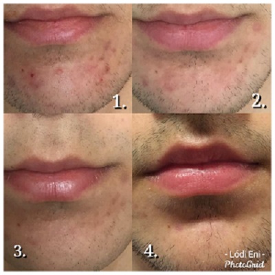 dunakeszi göd fót vác újpest tetoválás eltávolítás férfi intimgyanta szempilla lifting szempilla dauer thesera theresa bioszálas facelifting férfi intimgyanta kozmetikus kozmetika