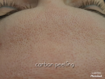 dunakeszi thesera theresa bioszálas facelifting férfi intimgyanta göd fót vác újpest tetoválás eltávolítás férfi intimgyanta szempilla lifting szempilla dauer kozmetikus kozmetika