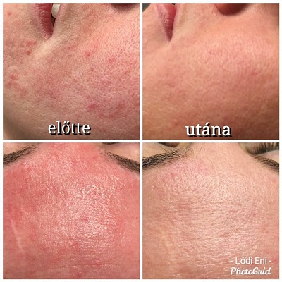 dunakeszi göd fót vác újpest tetoválás eltávolítás férfi intimgyanta szempilla lifting thesera theresa bioszálas facelifting férfi intimgyanta szempilla dauer kozmetikus kozmetika