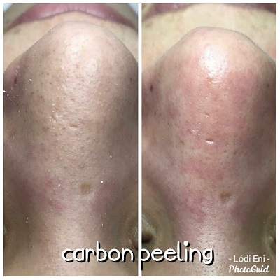 dunakeszi thesera theresa bioszálas facelifting férfi intimgyanta göd fót vác újpest tetoválás eltávolítás férfi intimgyanta szempilla lifting szempilla dauer kozmetikus kozmetika