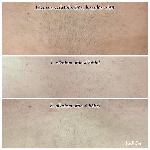 végleges szőrtelenítés lézeres szőrtelenítés