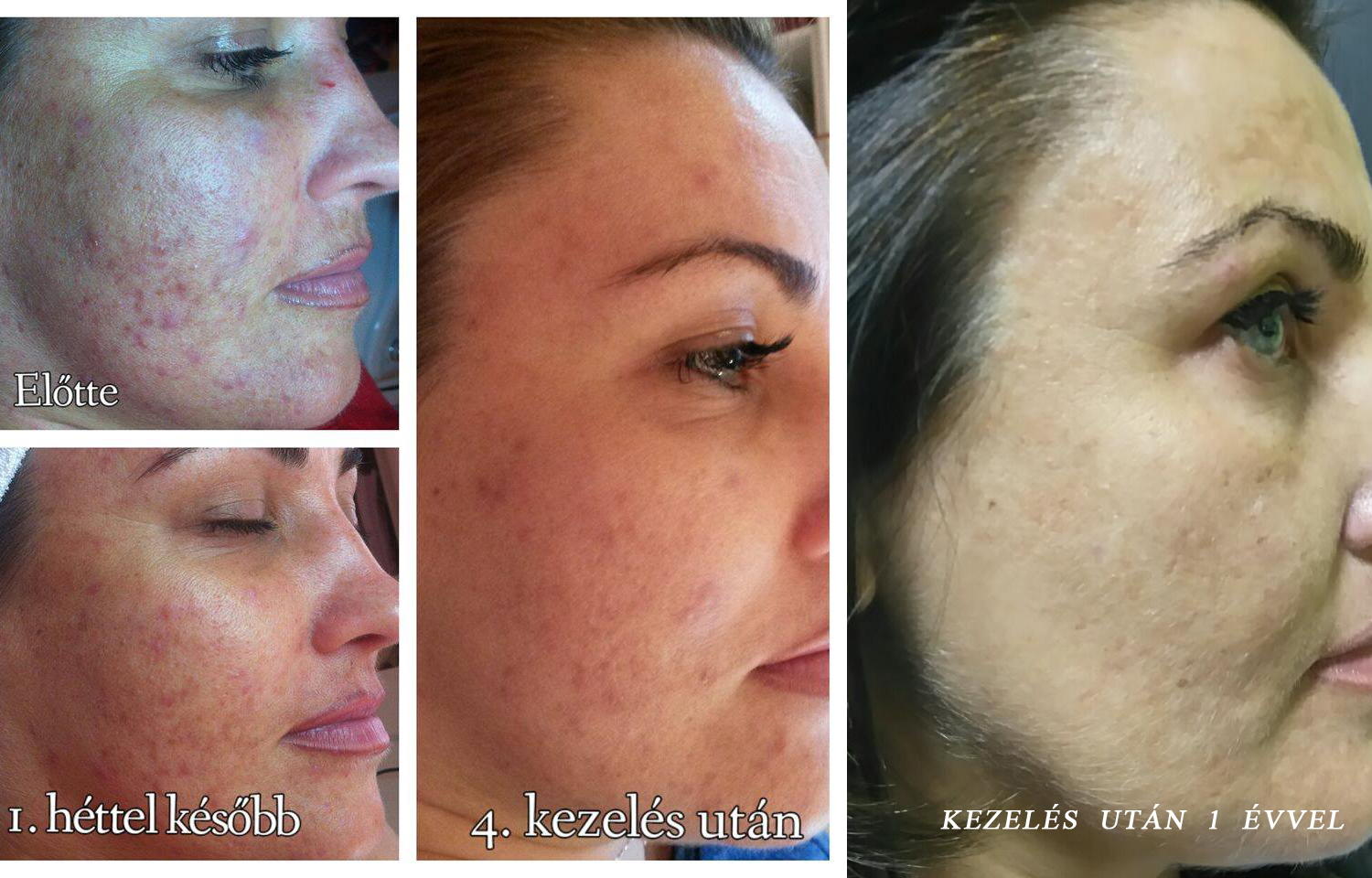 dermaroller kozmetika kozmetikus pigment halványítás hegkezelés aknés bőr dunakeszi végleges lézeres szőrtelenítés theresa thesera bioszálas facelifting férfi intimgyanta kozmetikus