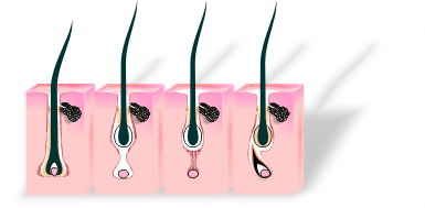 végleges tartós szőrtelenítés epilálás dunakeszi thesera theresa bioszálas facelifting férfi intimgyanta fót göd vác