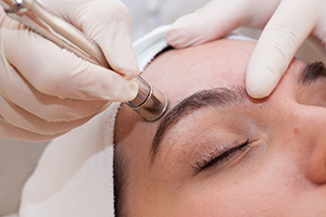 dunakeszi tinikezelés mikrodermabrázió hidroabrázió kozmetikus dermaroller thesera theresa bioszálas facelifting férfi intimgyanta mezoterápia