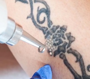 lézer carbon peeling carbonpeeling dermaroller rosacea thesera theresa bioszálas facelifting férfi intimgyanta dunakeszi lézeres szőrtelenítés göd fót vác újpest tetoválás eltávolítás férfi intimgyanta szempilla lifting szempilla dauer kozmetikus kozmetika